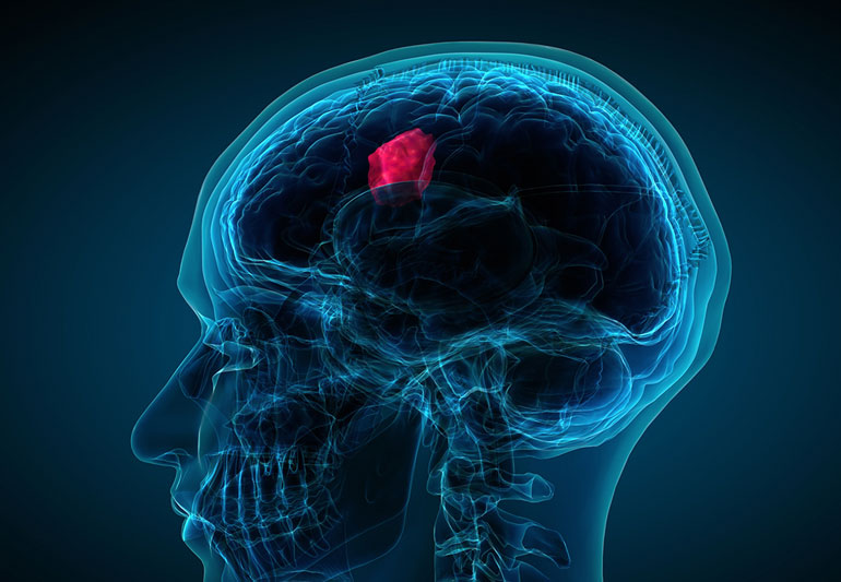 Brain Tumor Specialist in Jalandhar Punjab