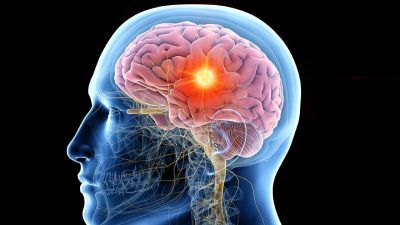 Epilepsy Specialist in Jalandhar Punjab