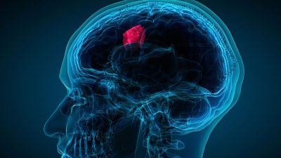 Brain Tumor Specialist in Jalandhar Punjab